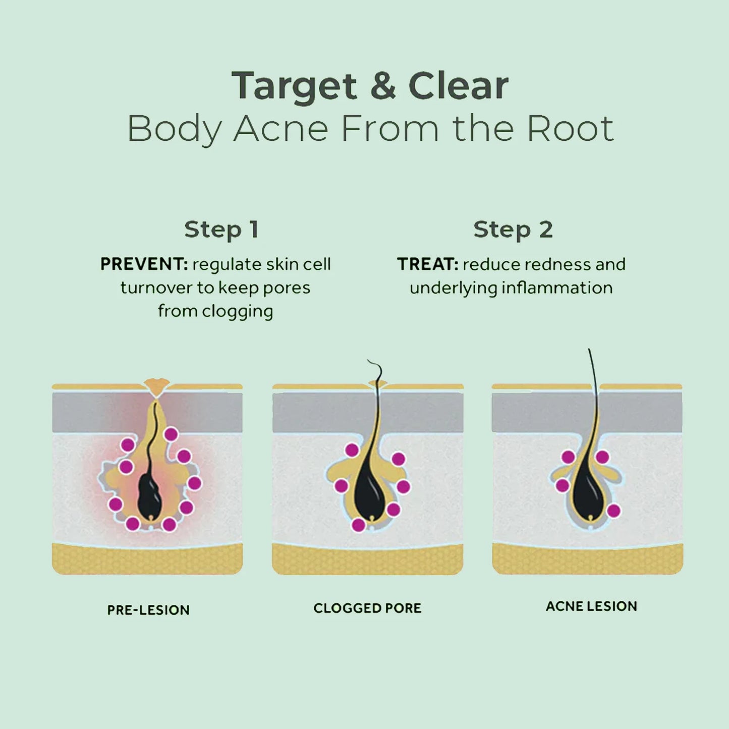 Back Acne Repair Spray