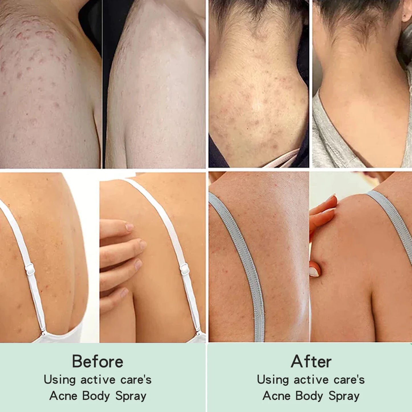 Back Acne Repair Spray
