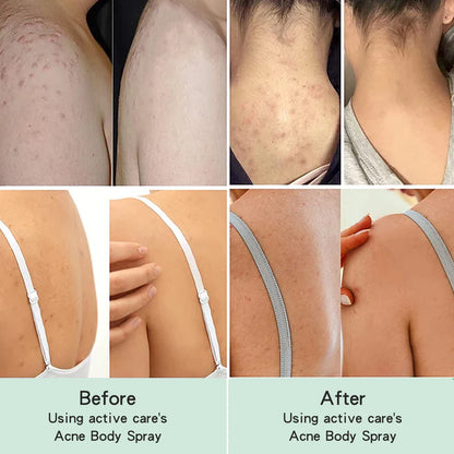 Back Acne Repair Spray