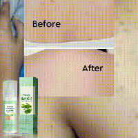 Back Acne Repair Spray