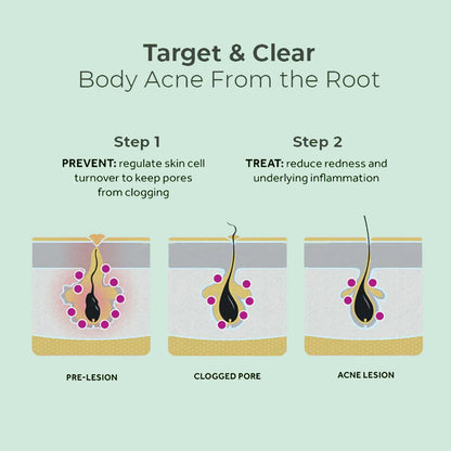 Back Acne Repair Spray