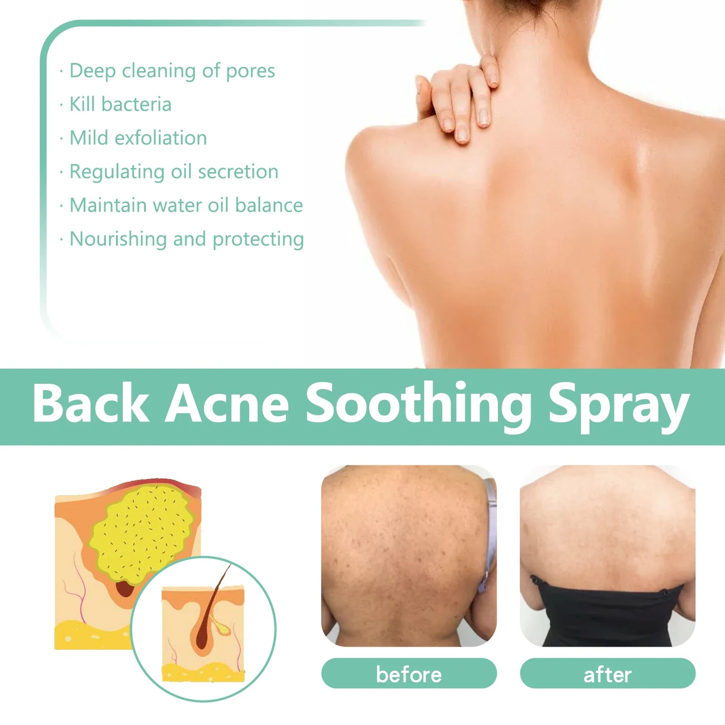 Back Acne Repair Spray